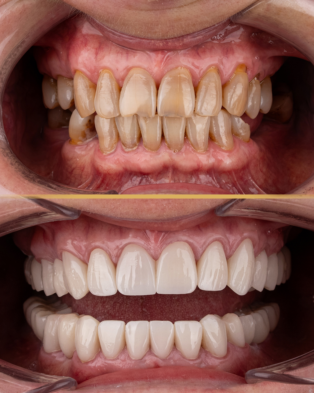 fixed retainers vs removable retainers